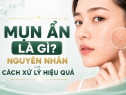 Mụn Ẩn Là Gì? Nguyên Nhân Và Cách Xử Lý Hiệu Quả