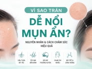 Mụn Ẩn Trên Trán: Nguyên Nhân Và Cách Xử Lý Hiệu Quả