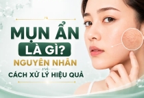 Mụn Ẩn Là Gì? Nguyên Nhân Và Cách Xử Lý Hiệu Quả