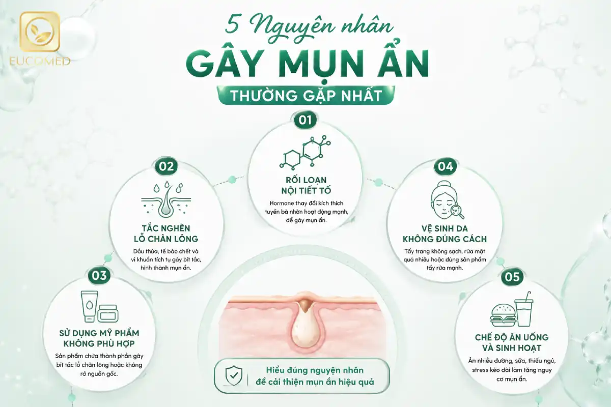 nguyên nhân gây mụn ẩn