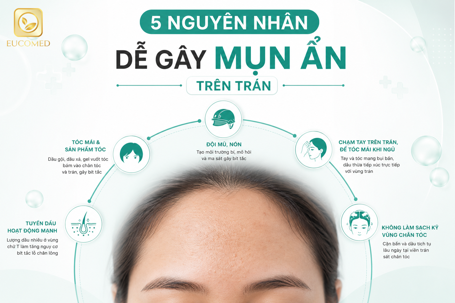 nguyên nhân mụn ẩn trên trán