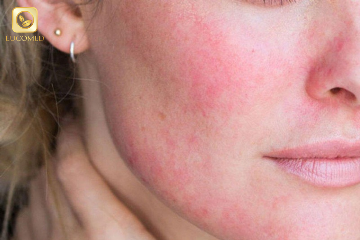 da nhiễm corticoid  là gì