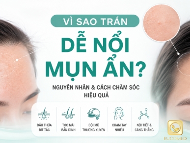 Mụn Ẩn Trên Trán: Nguyên Nhân Và Cách Xử Lý Hiệu Quả